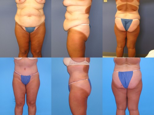 Tummy Tuck Before/After Photos