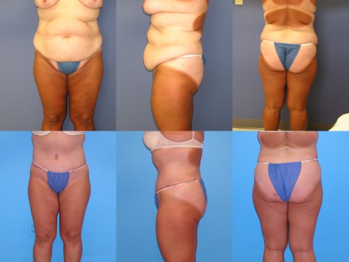 Swelling after Tummy Tuck Surgery? - Cherup, Lori ()