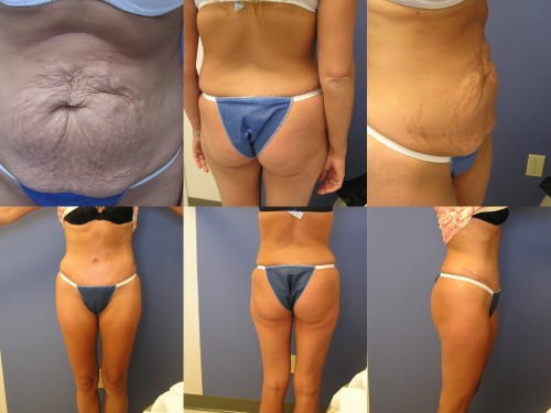 Tummy Tuck Before/After Photos