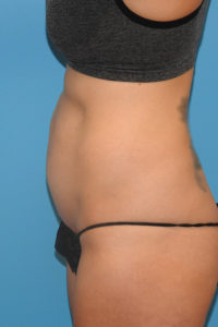 CoolSculpting