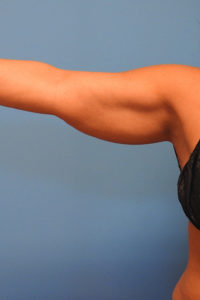 CoolSculpting® Elite