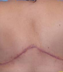 Breast Reconstruction with Flaps