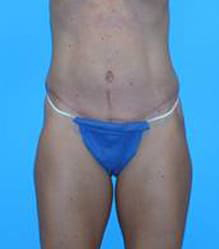 Tummy Tuck