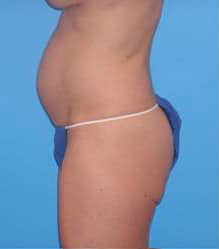 Tummy Tuck