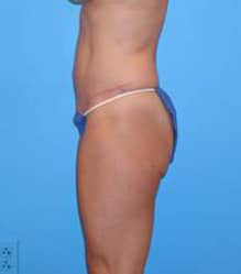 Tummy Tuck