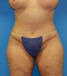 Tummy Tuck