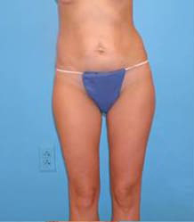 Tummy Tuck