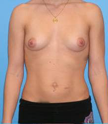 Breast Augmentation (Saline)