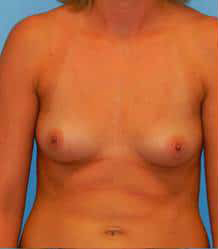 Breast Augmentation (Saline)