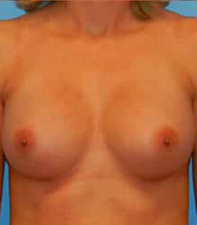 Breast Augmentation (Saline)