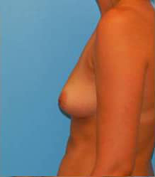 Breast Augmentation (Saline)