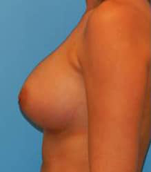 Breast Augmentation (Saline)