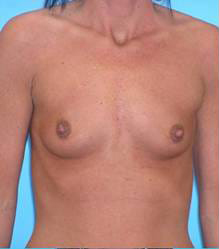 Breast Augmentation (Saline)