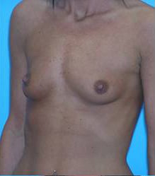 Breast Augmentation (Saline)