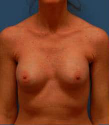 Breast Augmentation (Saline)