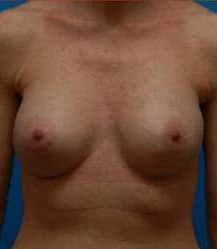 Breast Augmentation (Saline)