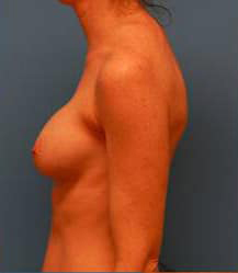 Breast Augmentation (Saline)