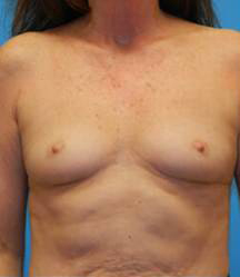 Breast Augmentation (Saline)