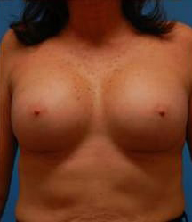 Breast Augmentation (Saline)