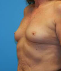 Breast Augmentation (Saline)