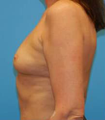 Breast Augmentation (Saline)