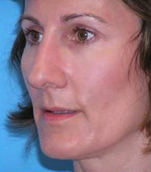 Rhinoplasty