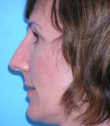 Rhinoplasty