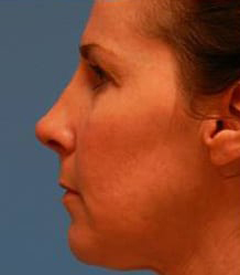 Rhinoplasty