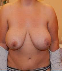 Breast Lift/Mastopexy