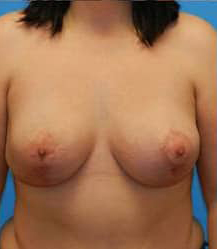 Breast Lift/Mastopexy