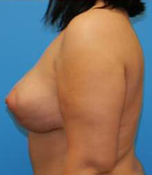 Breast Lift/Mastopexy