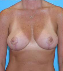 Breast Lift/Mastopexy