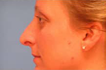 Rhinoplasty