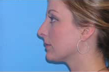 Rhinoplasty