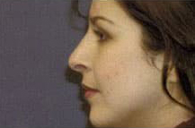 Rhinoplasty