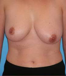 Breast Lift/Mastopexy