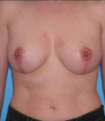 Breast Lift/Mastopexy