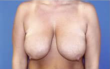 Breast Lift/Mastopexy