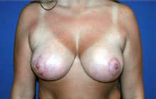 Breast Lift/Mastopexy