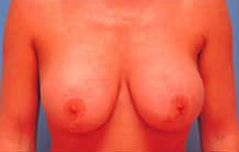 Breast Lift/Mastopexy