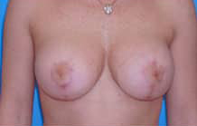 Breast Lift/Mastopexy