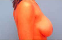 Breast Lift/Mastopexy