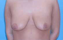 Breast Lift/Mastopexy