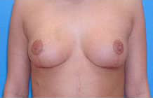 Breast Lift/Mastopexy