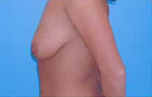 Breast Lift/Mastopexy