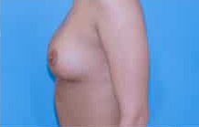 Breast Lift/Mastopexy