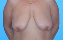 Breast Lift/Mastopexy