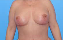 Breast Lift/Mastopexy