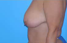 Breast Lift/Mastopexy