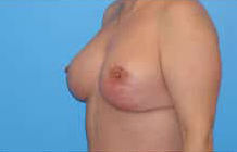 Breast Lift/Mastopexy